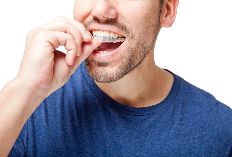 Benefits of Invisalign